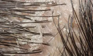 Närbild på hårbotten med torr hud i ansiktet flagnar och synliga hårstrån.