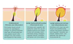 Illustrationer visar olika typer av akne: pormaskar, inflammatorisk akne och svår inflammatorisk akne. En stor pormask på ryggen kan vara ett tidigt tecken.