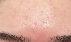 Hud med rodnad och små utslag på pannan, möjligen niacinamide biverkningar.