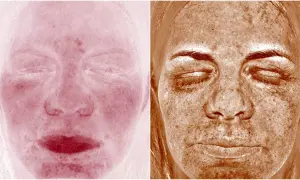 Två bilder av ansikten. Vänster visar rodnad, möjligen perioral dermatit. Höger visar solskador med mörka fläckar.