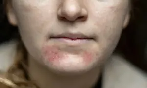 Närbild på en persons mun och haka med rodnad och utslag som tyder på eksem i ansiktet.