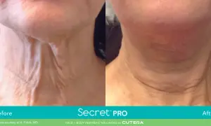 Före- och efterbilder på en hals med tydliga veck. Efterbehandlingen med Secret™ PRO har minskat synligheten av veck på halsen.