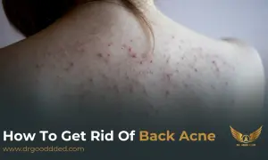 Närbild på en rygg med synlig akne. Texten "How To Get Rid Of Back Acne" antyder en lösning på problemet.