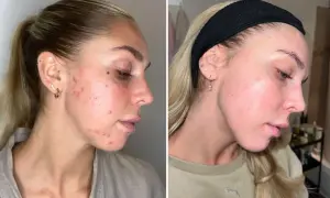 Före- och efterbilder visar en kvinnas ansikte med hormonell akne som förbättrats avsevärt.