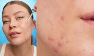 Närbild på hud med finnar på hakan. En droppe serum appliceras med pipett.