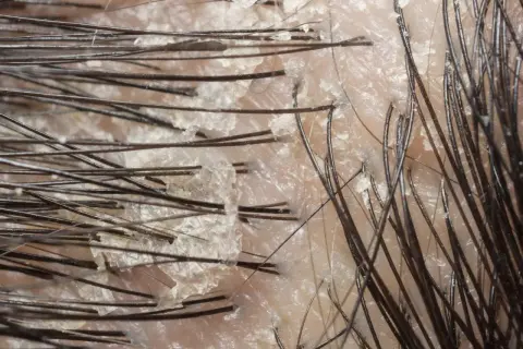 Närbild på hårbotten med torr hud i ansiktet flagnar och synliga hårstrån.