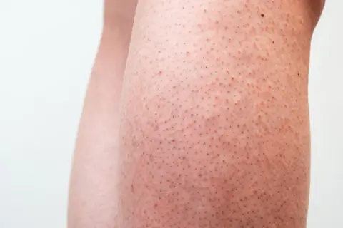 Närbild på ben med små prickar som liknar jordgubbsben.