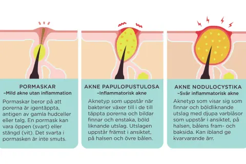 Illustrationer visar olika typer av akne: pormaskar, inflammatorisk akne och svår inflammatorisk akne. En stor pormask på ryggen kan vara ett tidigt tecken.