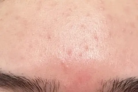 Hud med rodnad och små utslag på pannan, möjligen niacinamide biverkningar.