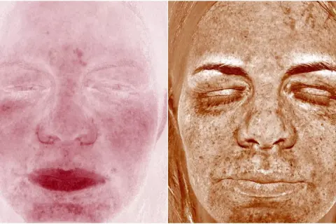Två bilder av ansikten. Vänster visar rodnad, möjligen perioral dermatit. Höger visar solskador med mörka fläckar.
