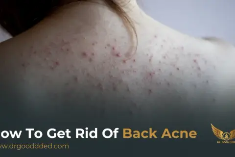 Närbild på en rygg med synlig akne. Texten "How To Get Rid Of Back Acne" antyder en lösning på problemet.