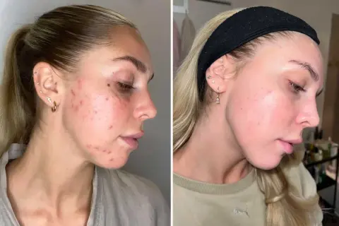 Före- och efterbilder visar en kvinnas ansikte med hormonell akne som förbättrats avsevärt.