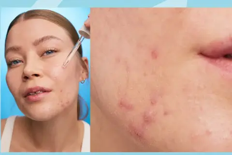 Närbild på hud med finnar på hakan. En droppe serum appliceras med pipett.