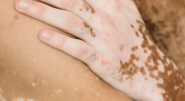 En hand med vitiligo, där vita prickar på huden skapar ett unikt mönster.