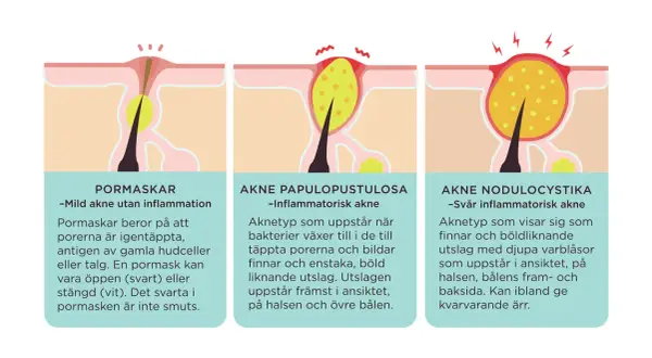 Illustrationer visar olika typer av akne: pormaskar, inflammatorisk akne och svår inflammatorisk akne. En stor pormask på ryggen kan vara ett tidigt tecken.