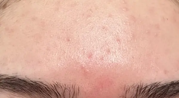 Hud med rodnad och små utslag på pannan, möjligen niacinamide biverkningar.