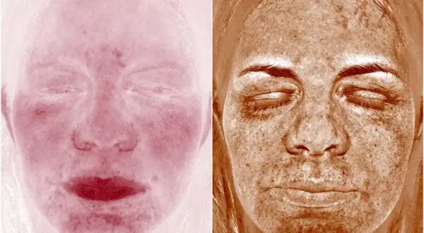 Två bilder av ansikten. Vänster visar rodnad, möjligen perioral dermatit. Höger visar solskador med mörka fläckar.