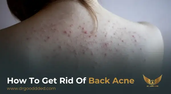 Närbild på en rygg med synlig akne. Texten "How To Get Rid Of Back Acne" antyder en lösning på problemet.