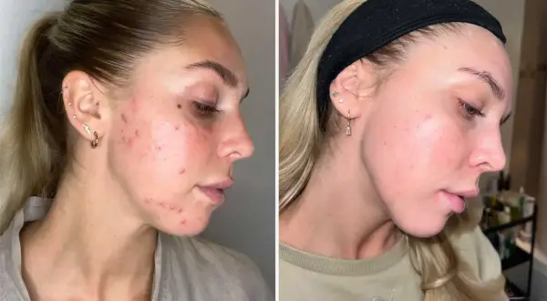 Före- och efterbilder visar en kvinnas ansikte med hormonell akne som förbättrats avsevärt.