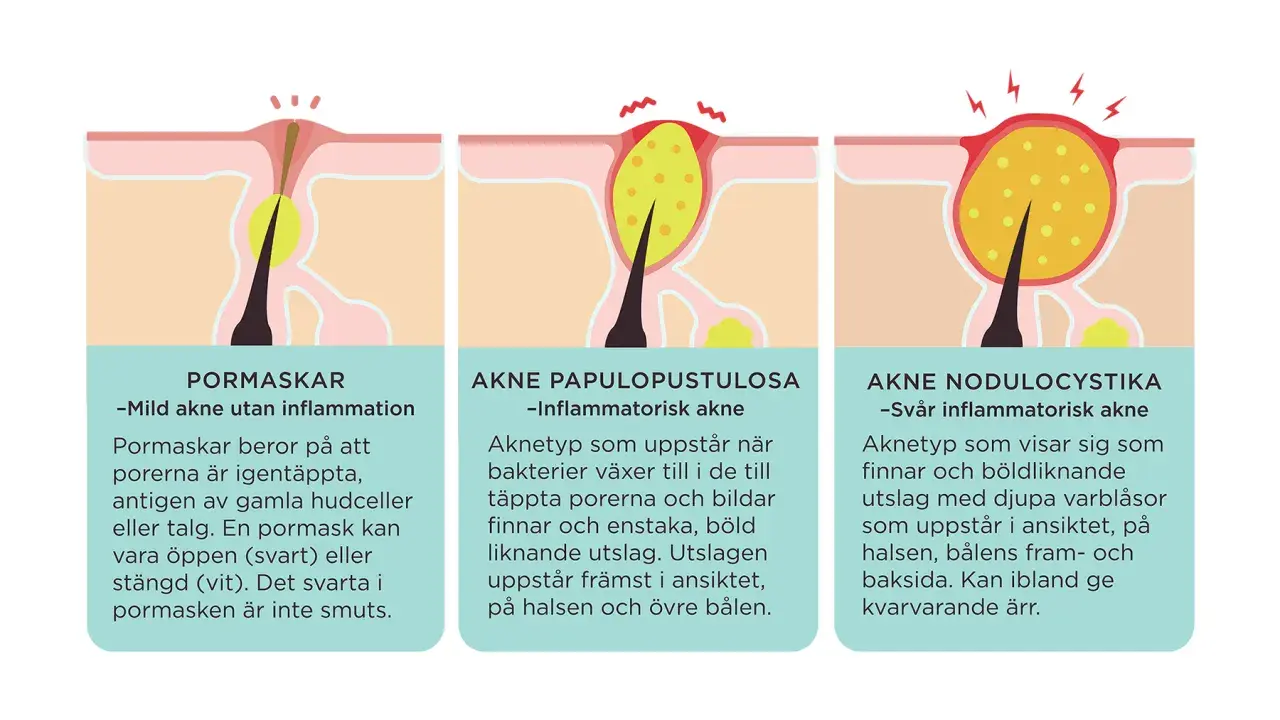 Illustrationer visar olika typer av akne: pormaskar, inflammatorisk akne och svår inflammatorisk akne. En stor pormask på ryggen kan vara ett tidigt tecken.