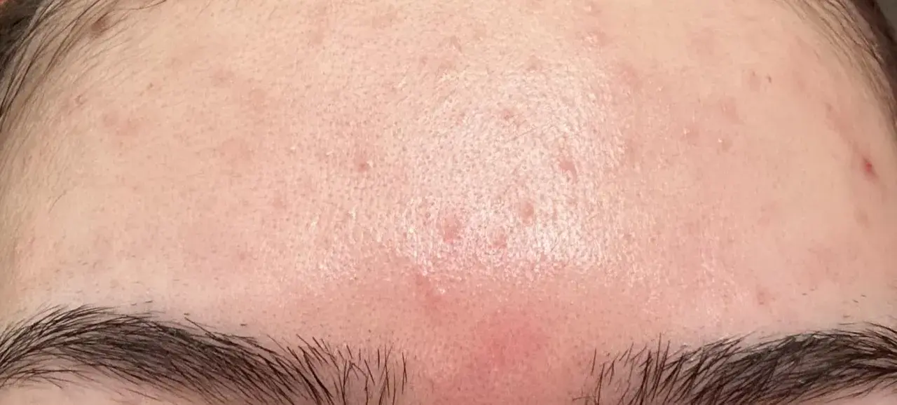 Hud med rodnad och små utslag på pannan, möjligen niacinamide biverkningar.