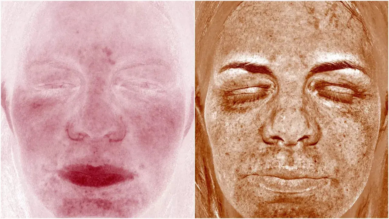 Två bilder av ansikten. Vänster visar rodnad, möjligen perioral dermatit. Höger visar solskador med mörka fläckar.