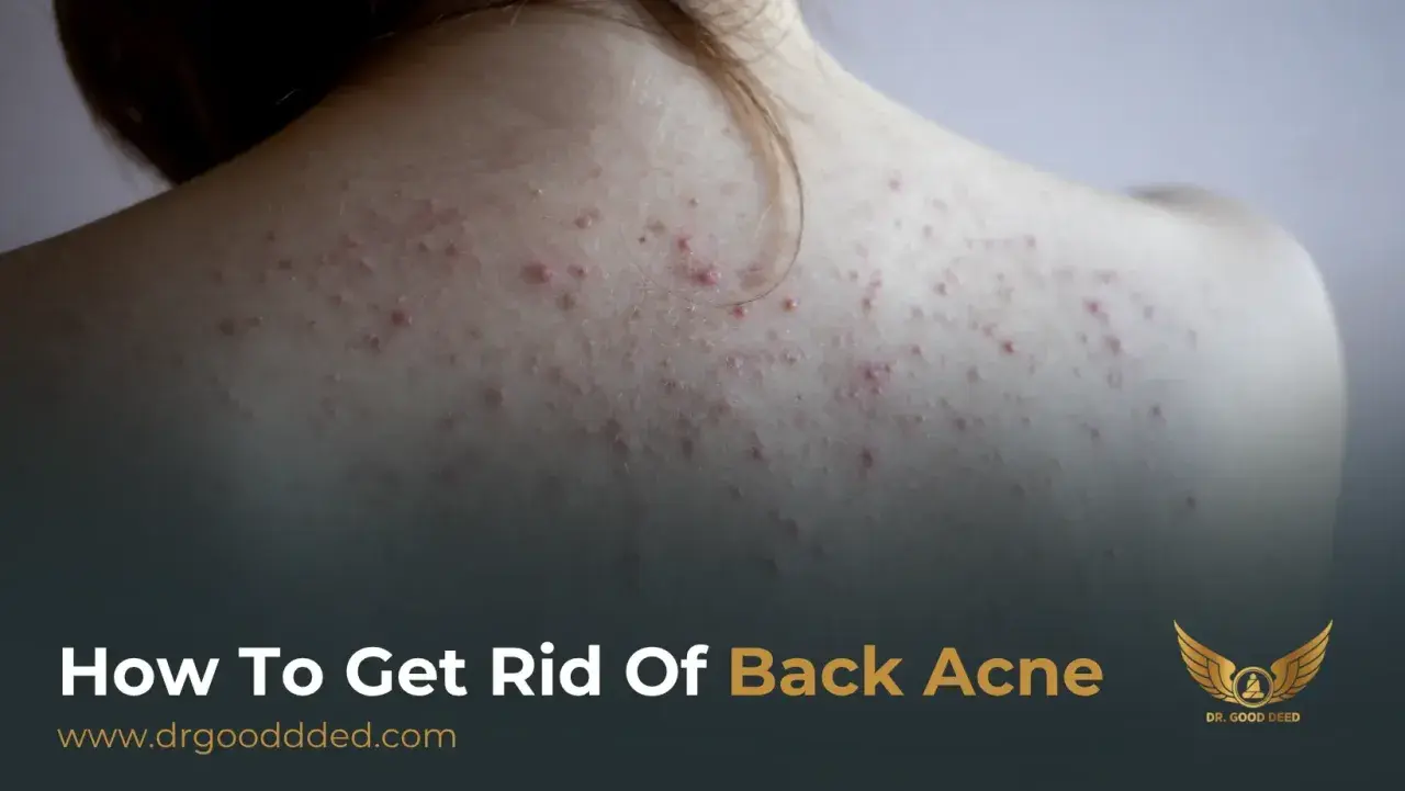 Närbild på en rygg med synlig akne. Texten "How To Get Rid Of Back Acne" antyder en lösning på problemet.