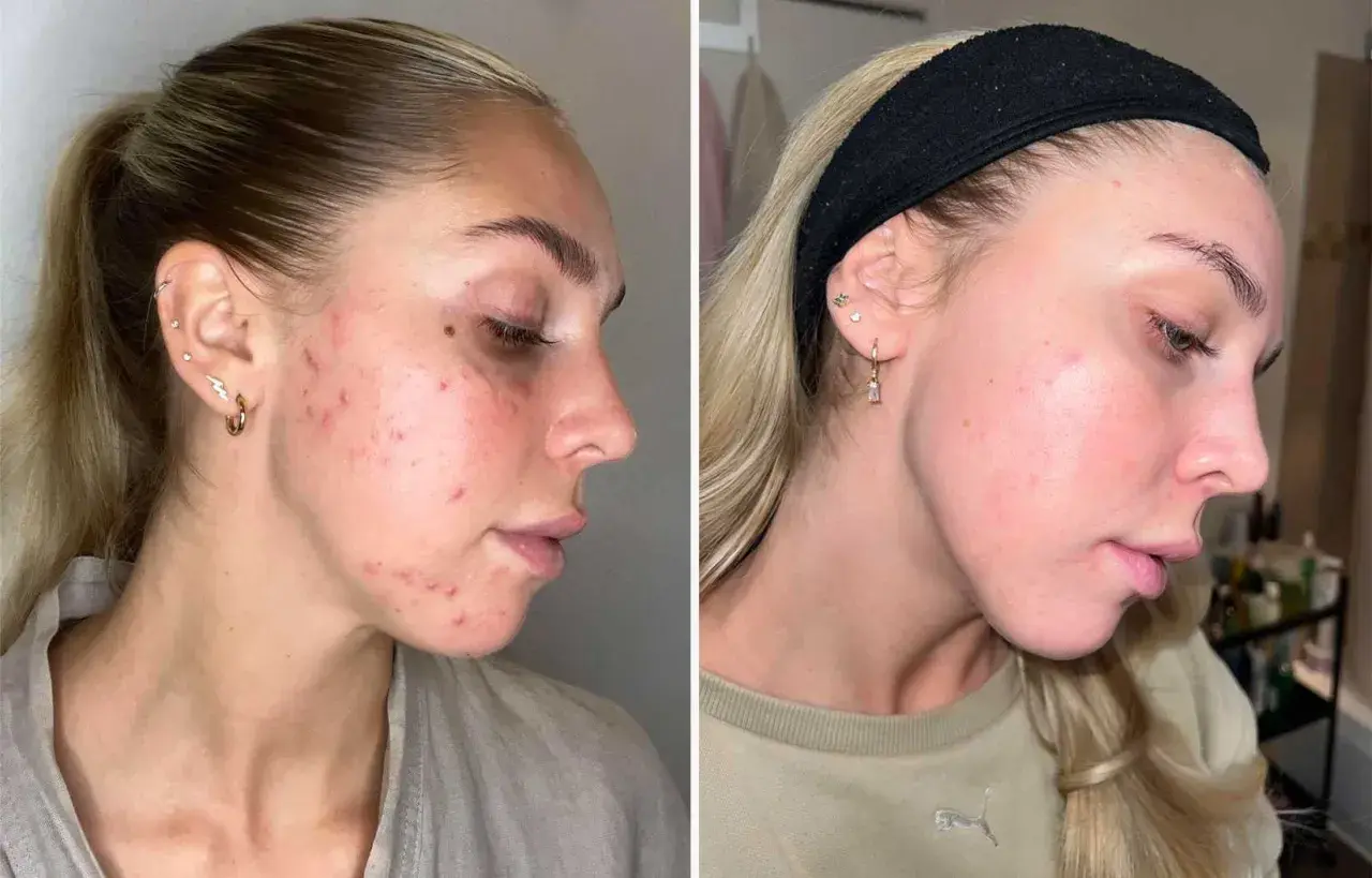 Före- och efterbilder visar en kvinnas ansikte med hormonell akne som förbättrats avsevärt.