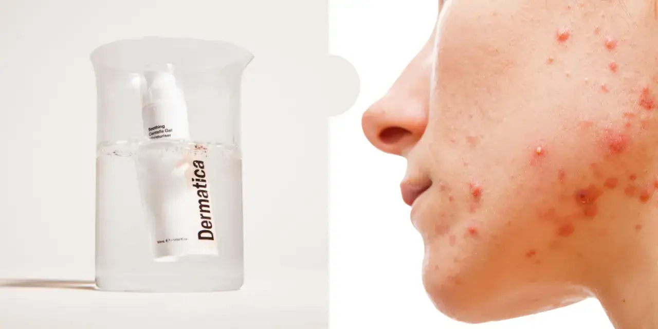Dermatologiskt läppbalsam i ett provrör med vatten, bredvid en närbild av en persons ansikte med hormonell akne.