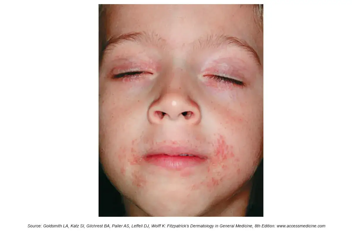Barn med rodnad och utslag runt munnen, möjligen perioral dermatit. Sol kan förvärra tillståndet.