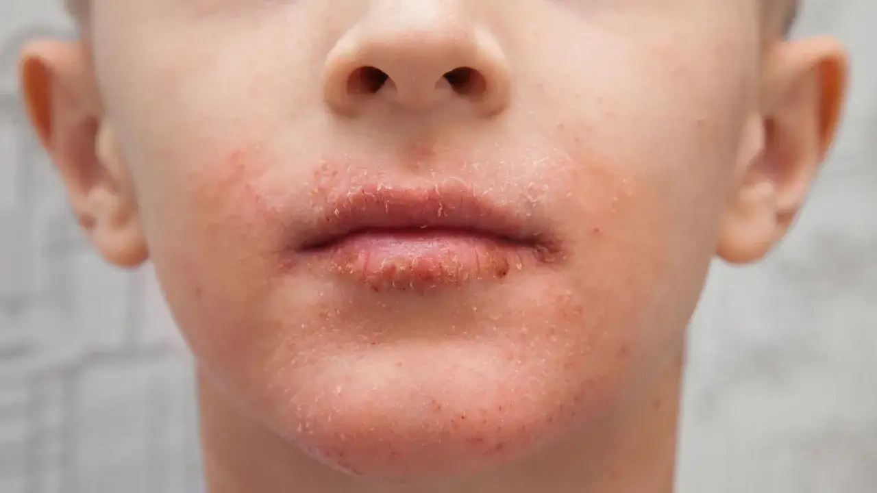 Närbild på ett barns mun och haka med rodnad och fjällande hud, tecken på perioral dermatit.