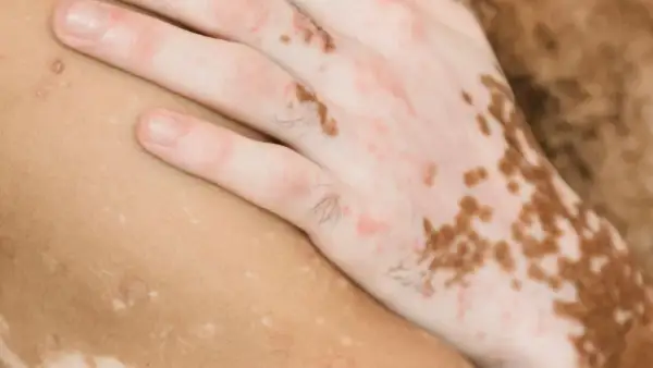 En hand med vitiligo, där vita prickar på huden skapar ett unikt mönster.