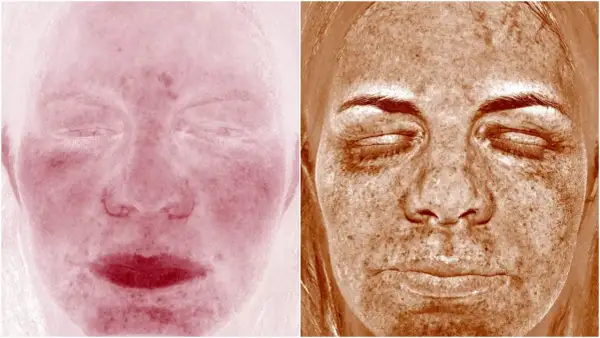Två bilder av ansikten. Vänster visar rodnad, möjligen perioral dermatit. Höger visar solskador med mörka fläckar.